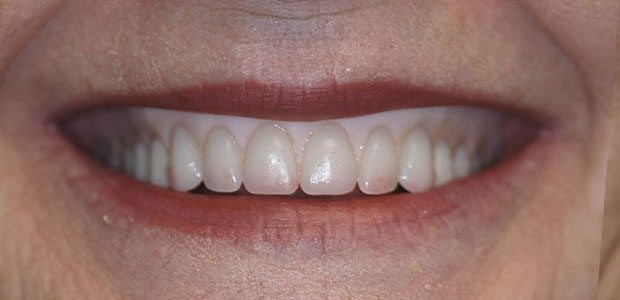 Suction Dentures San Carlos AZ 85550